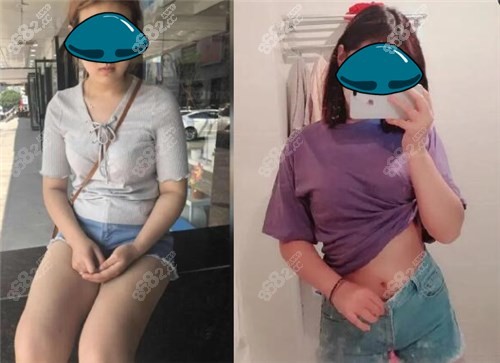 苏州康美医院大腿吸脂和腰腹吸脂案例效果图