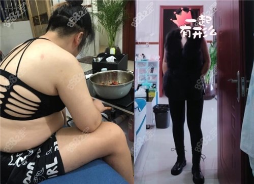 苏州康美医疗美容医院全身吸脂案例
