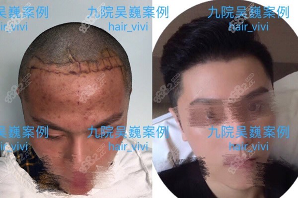 吴巍医生,是上海九院植发科主任,好多脱发发友都想找她种植头发
