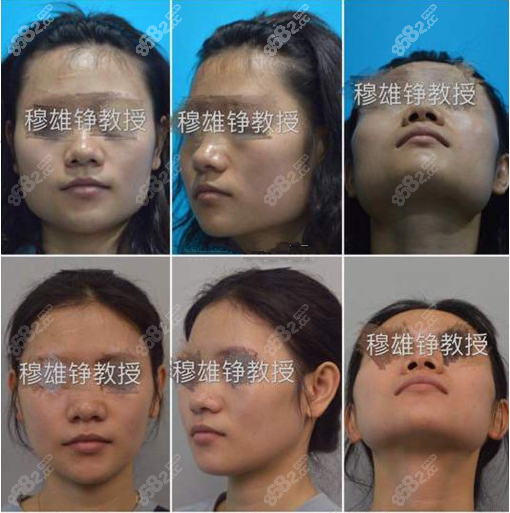 <!--<i data=20240705-sp></i>-->下颌骨整形真人案例对比