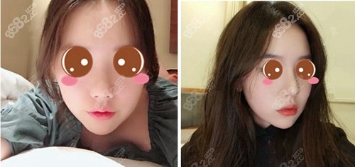 谢卫国院长隆鼻案例 谢卫国院长隆鼻案例