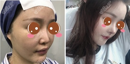 谢卫国院长做小翘鼻案例 谢卫国院长做小翘鼻案例