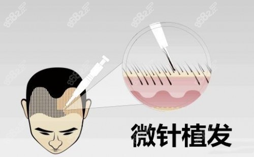 杭州薇琳植发中心做微针植发手术