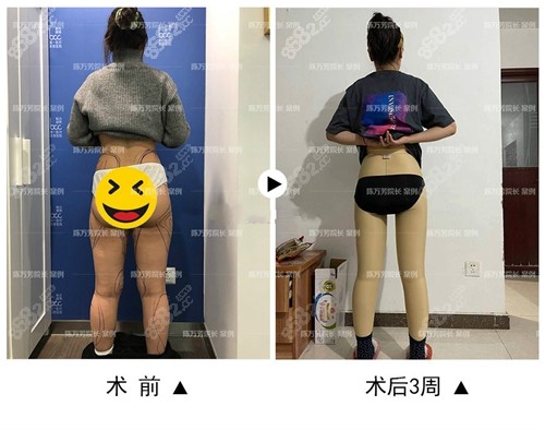 北京联合丽格陈万芳吸脂三个月对比图