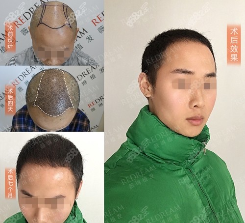 杭州薇琳植发头顶加密种植案例
