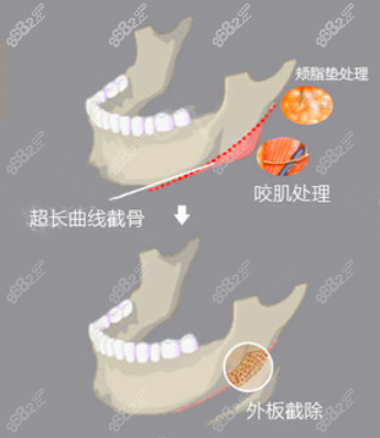 下颌角超长曲线截骨