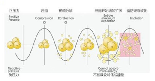 音塑皮层内熨吸脂技术