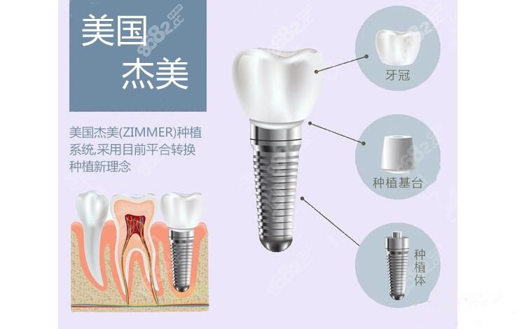 美国zimmer杰美种植体