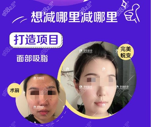 昆明梦想面部吸脂前后对比图