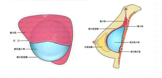 <!--<i data=20240705-sp></i>-->无 痛隆胸陈郇医生做胸痛不痛