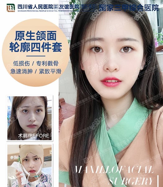 张立天医生做的面部轮廓四件套手术案例