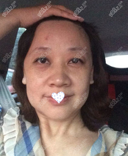 手术前的照片