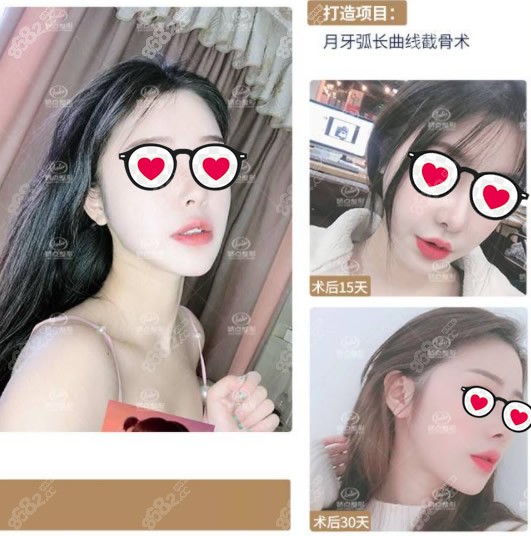 成都娇点姜宇禄医生下颌骨整形15天、30天效果图