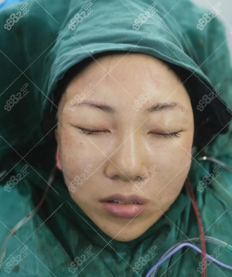 上海九院中下面部大拉皮手术即刻照片