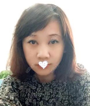 北京脸部大拉皮手术50天照片