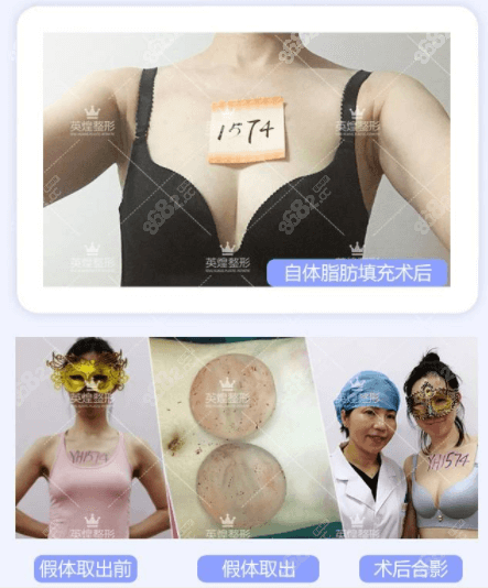 北京英煌赵丹杨做假体取出+脂肪丰胸案例