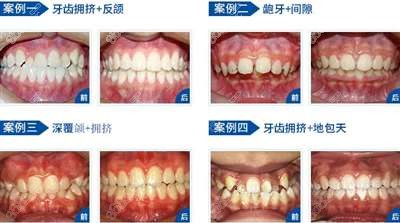 泰康拜博口腔牙齒矯正案例