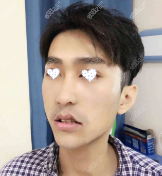 上海<!--<i data=20240705-sp></i>-->醫(yī)生雙顎手術(shù)20天照片
