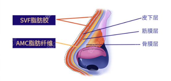 AMC脂肪纤维骨感隆鼻层次示意图