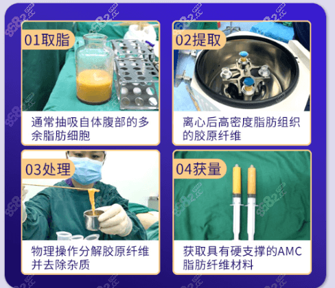 AMC脂肪纤维骨感隆鼻部分手术过程示意图