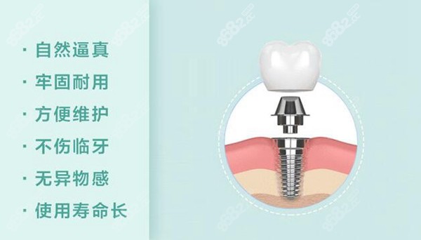 美国皓圣种植牙介绍