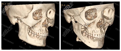 下颌角切除后CT拍摄效果