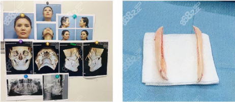 金一秀長曲線下頜角截骨出的下頜骨