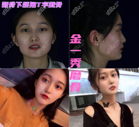 金一秀顴骨下頜角T字截骨案例對比圖