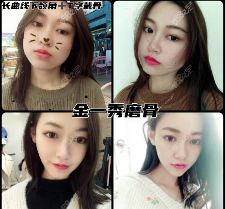 金一秀長曲線下頜角T字截骨案例對比圖