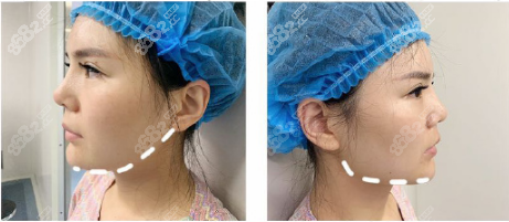 金一秀長曲線下頜角磨骨術(shù)后對比圖