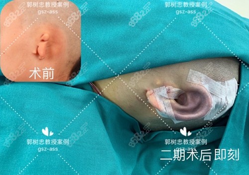 <!--<i data=20240705-sp></i>-->小耳畸形矫正案例前后对比