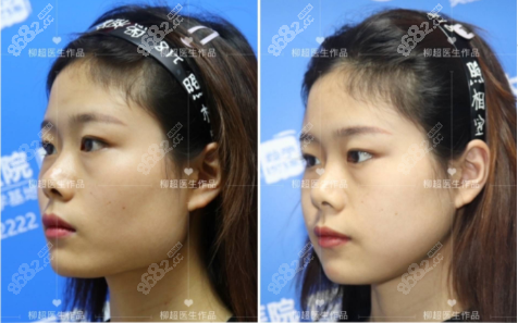 柳超超長(zhǎng)曲線下頜角截骨案例45°效果對(duì)比圖