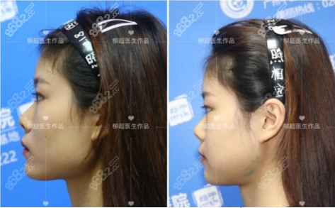 柳超超長(zhǎng)曲線下頜角截骨案例側(cè)面效果對(duì)比圖