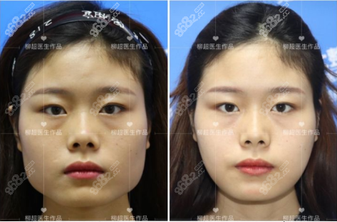 柳超超長(zhǎng)曲線下頜角截骨案例正面效果對(duì)比圖