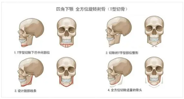 廣州柳超磨骨改臉型全過(guò)程