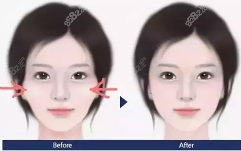 柳超磨骨案例圖效果怎樣？