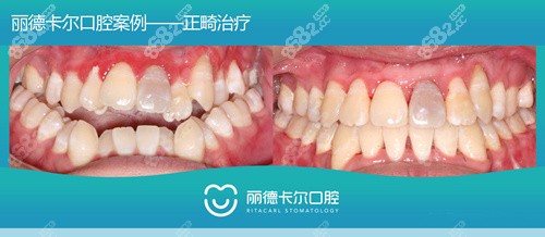 <!--<i data=20240705-sp></i>-->口腔正畸<span style=