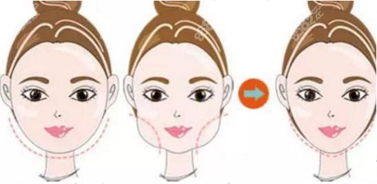 廣州柳超做磨骨改臉型技術(shù)高超