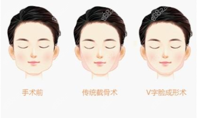 廣州柳超磨骨技術(shù)怎么樣