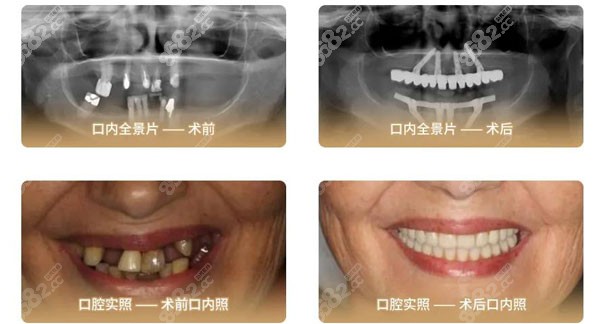 李阿姨做立得用全口种植牙的口腔实照