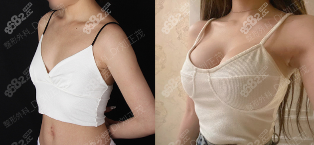 劉正茂內(nèi)窺鏡隆胸左側(cè)365cc右側(cè)340cc效果圖