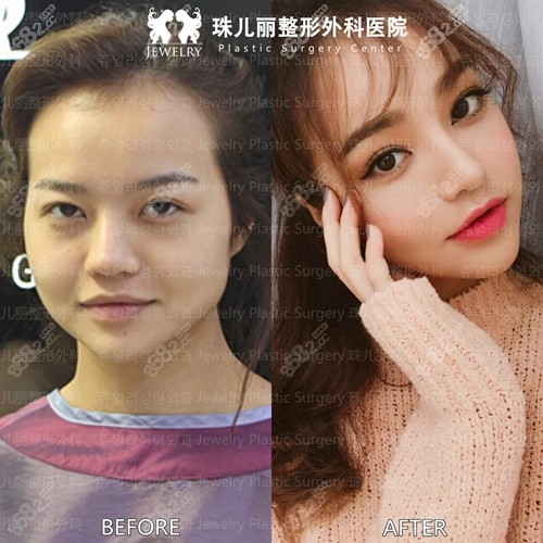 韩国珠儿丽方下颌手术案例