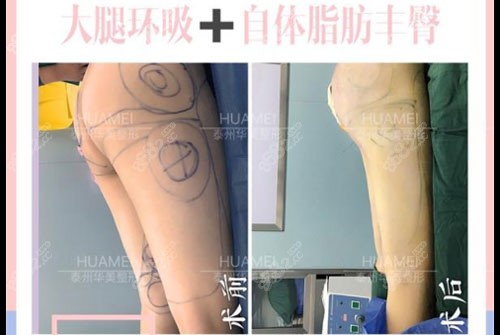 泰州苏王整形大腿吸脂+自体脂肪丰臀<span style=