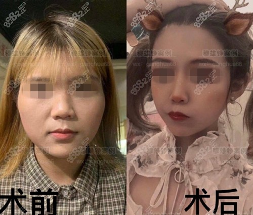 上海薇琳下颌角手术案例