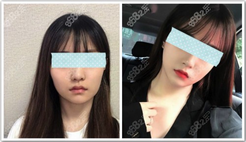 磨骨手术前后效果对比