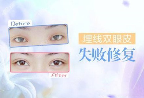 埋線雙眼皮失敗修復(fù)案例