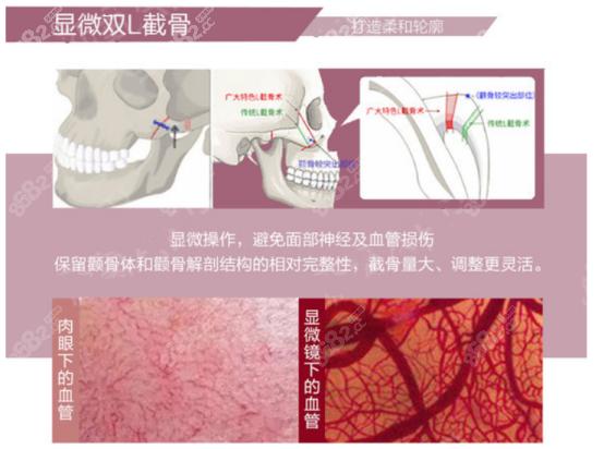 美联臣用的是双L截骨内推手术