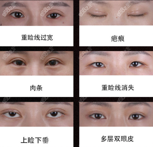 眼整形失败常见种类