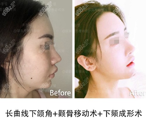 上海愉悦美联臣下颌角截骨案例