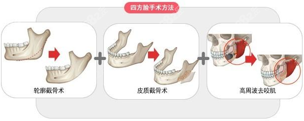 下颌角收费价格